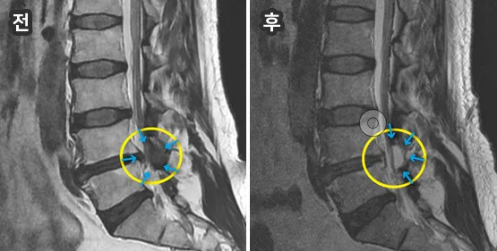 단일공 척추내시경 감압술 시술 전후 요추 MRI 비교